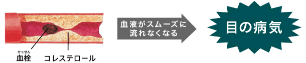 血流がスムーズに流れなくなる