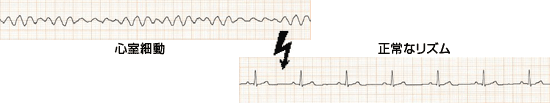 心室細動　⇒　正常なリズム