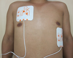 2．電極パッドを胸に貼る　写真
