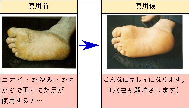 皮膚科で出る水虫の薬の効果、副作用 ステロ 