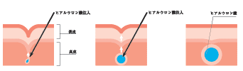 ヒアルウロン酸による回復のメカニズム