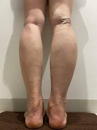 足のむくみ ふくらはぎの腫れ ひざ治療 手術 不要 膝サポーター 筋肉をつくります 足が軽い 即効効果 ふくらはぎパット 膝の痛み ひざに水がたまる時１０分解消 ひざの下の太ももがはれる むくむのをなくする方法 ひざの痛み 変形性ひざ軟骨症 ひざの変形