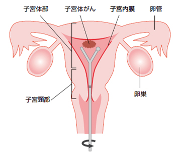 子宮体がん説明図
