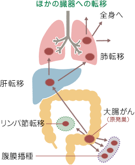 大腸 癌 肺 転移 余命