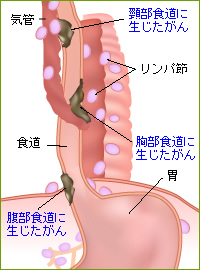 口臭 胃がん