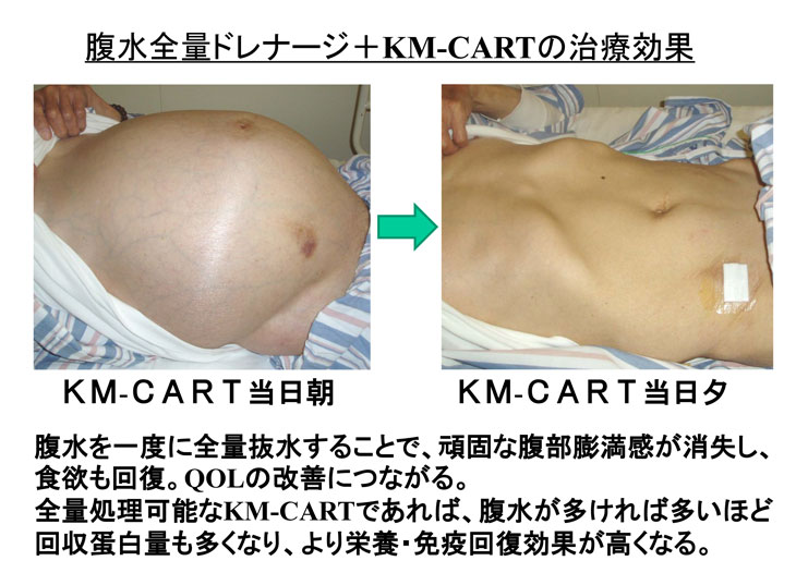 腹水 を 抜く 余命