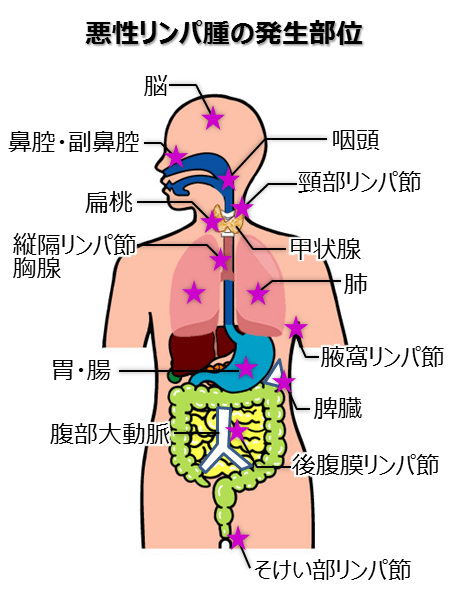 悪性リンパ腫再発余命