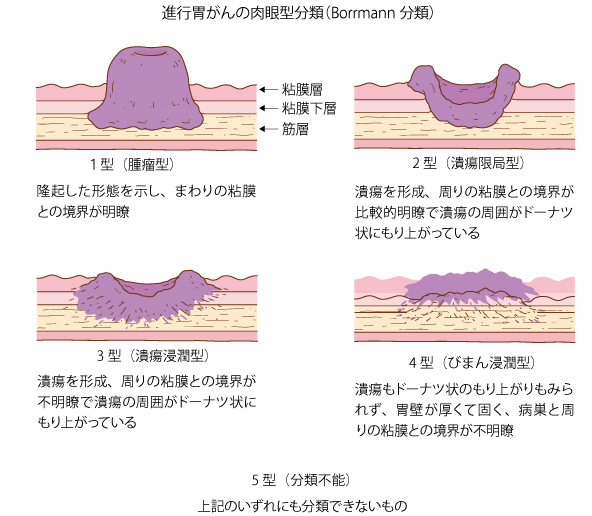 スキルス 胃がん