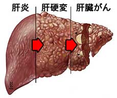 肝臓 癌 末期 急変