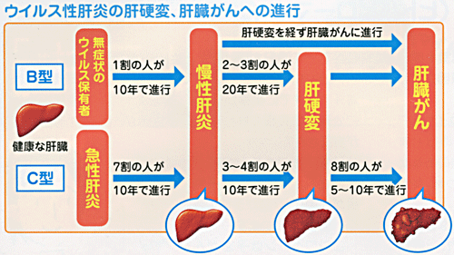 急性 劇 症 肝炎