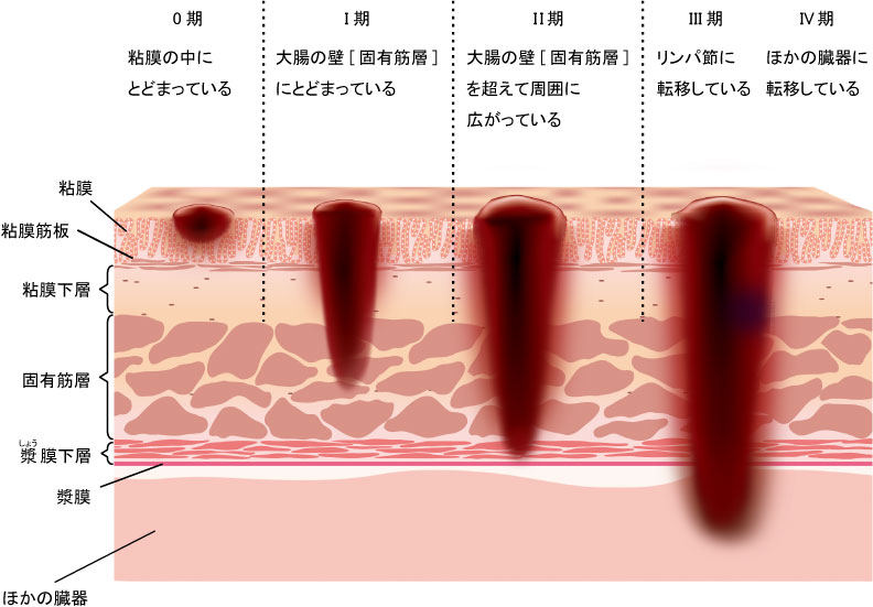 大腸癌