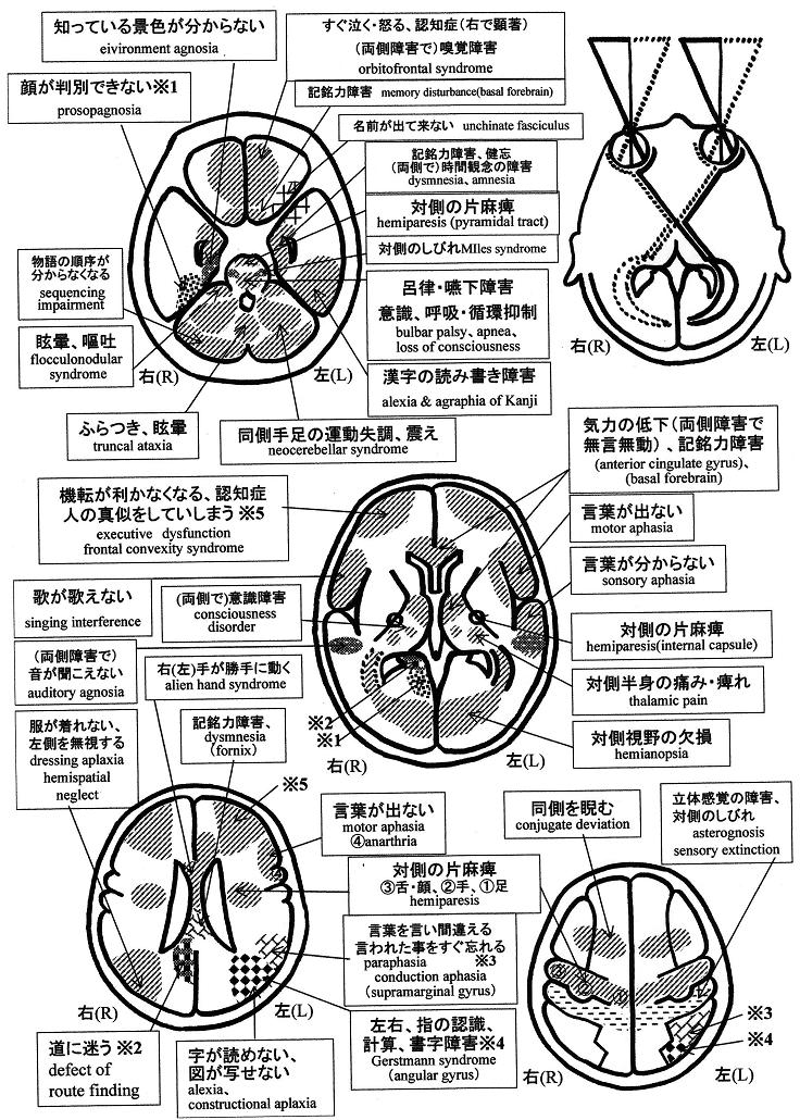 CT説明図