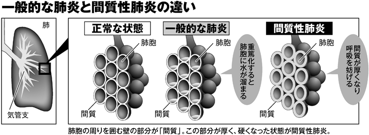 間 質 性 肺炎 治る