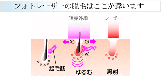 フォトレーザーの違い